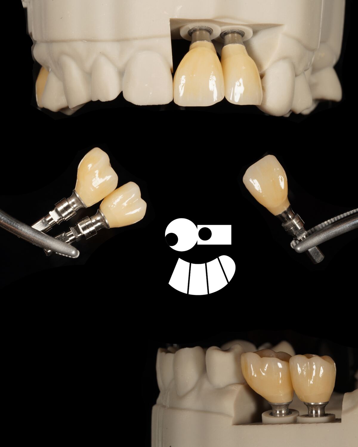 Custom Implant Restorations.