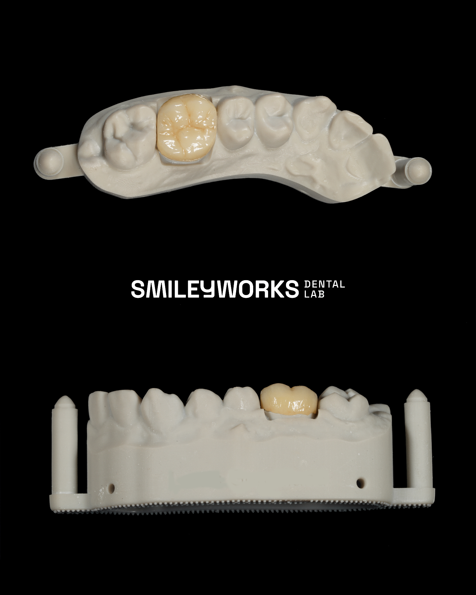 Monolithic Zirconia Crown