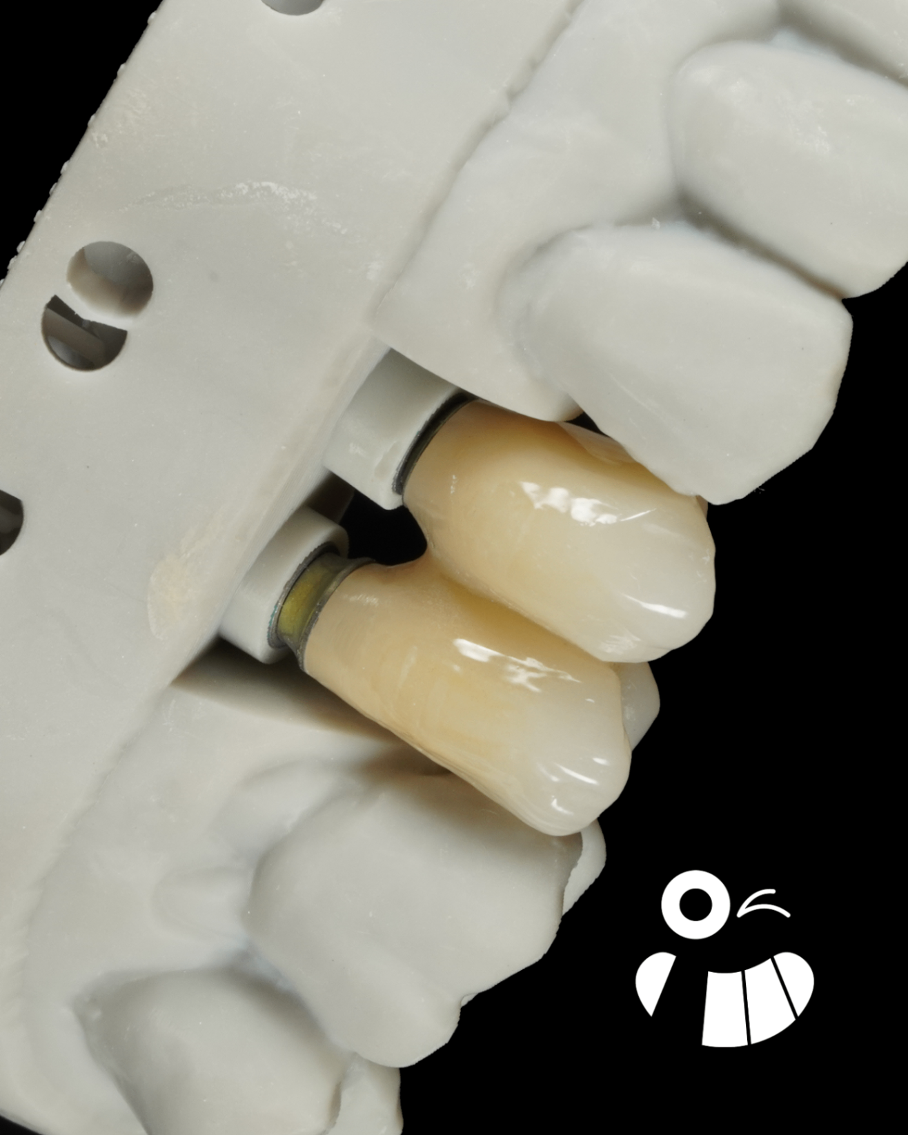 JD Evolution Implant