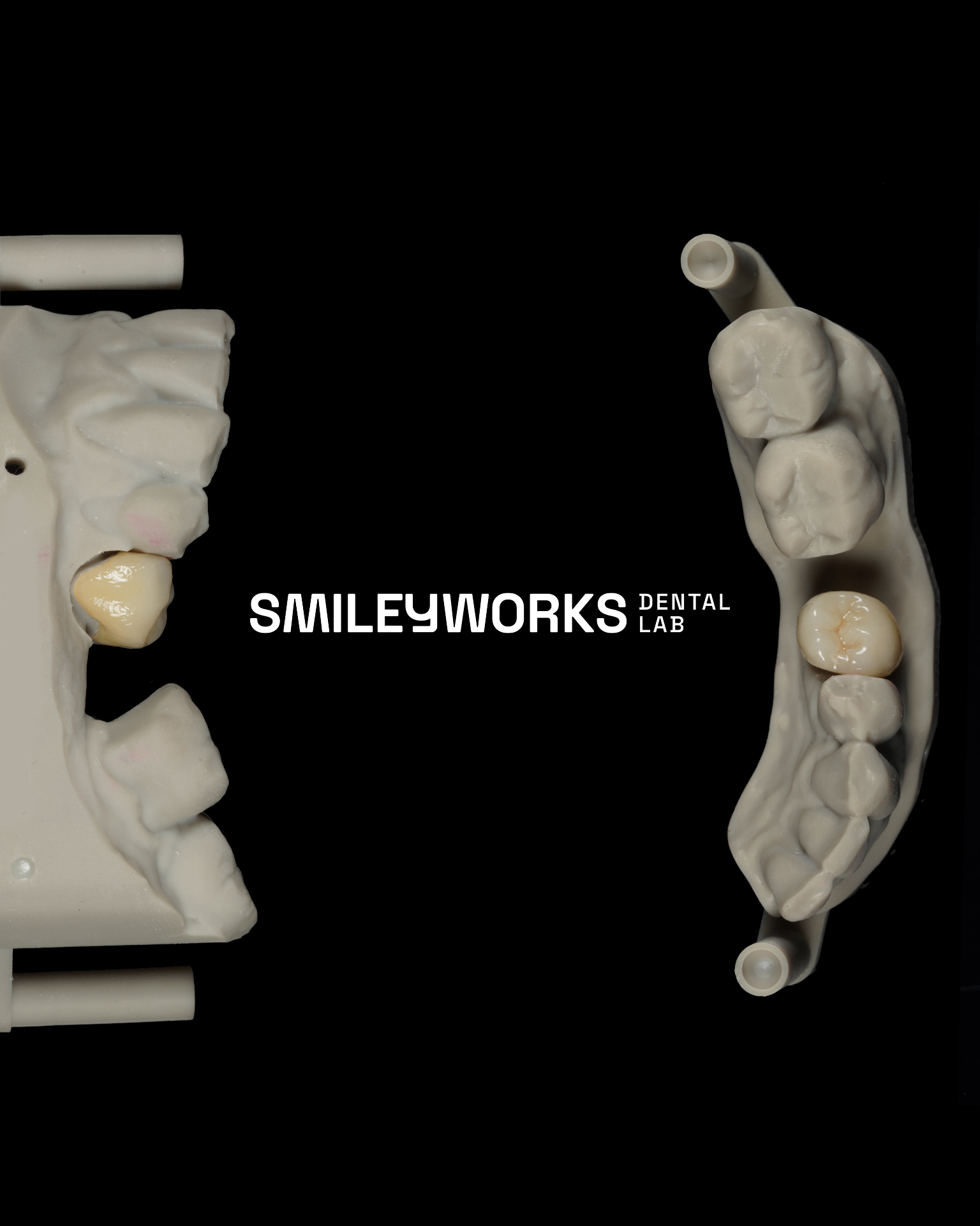 Monolithic Zirconia Crown