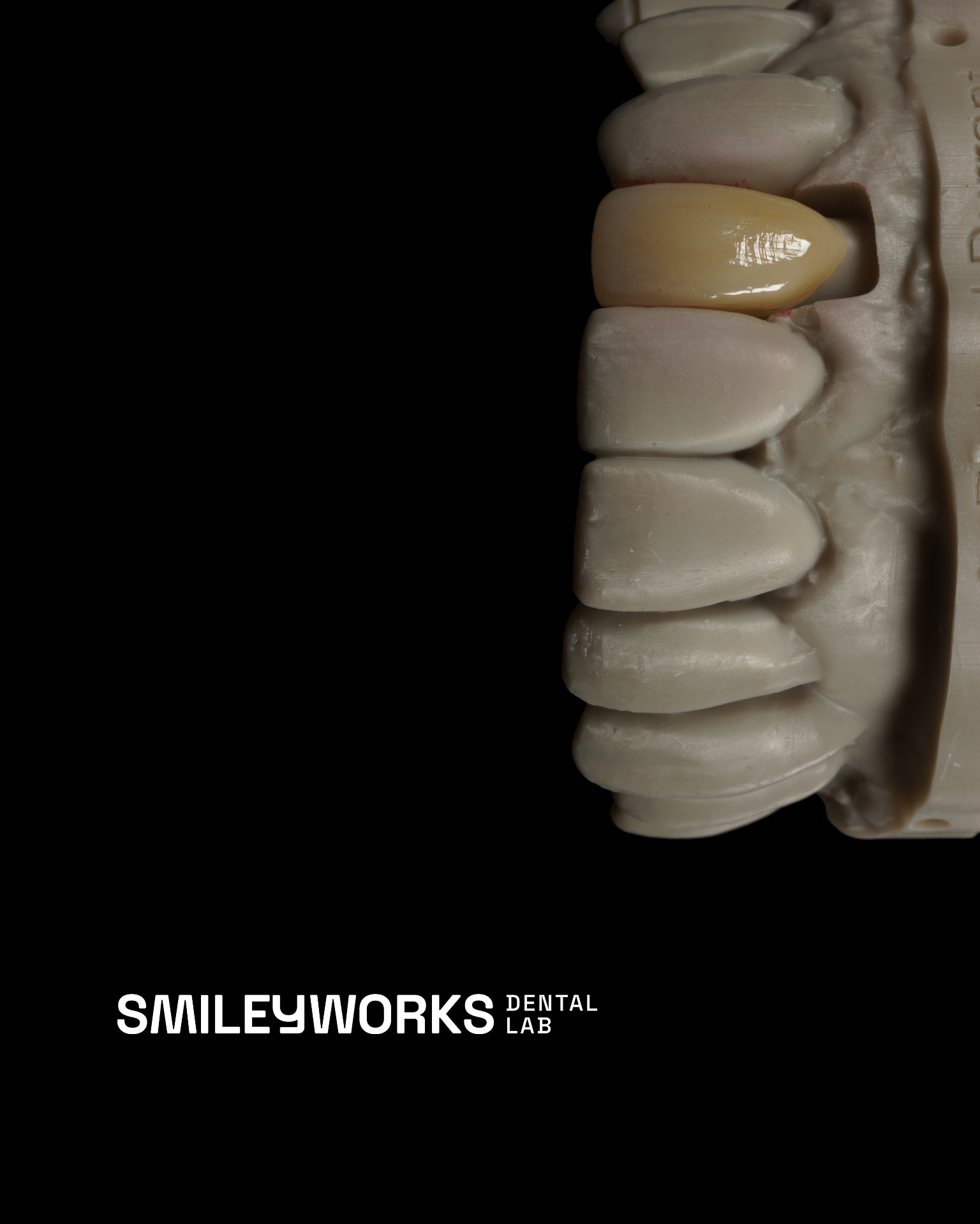 Lateral Zirconia Bridge